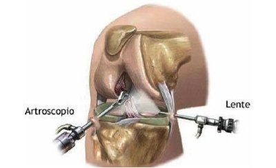 ARTROSCOPIA