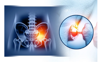 PRÓTESIS DE CADERA Y RODILLA