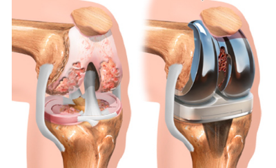 PRÓTESIS, LIGAMENTOS, MENISCOS